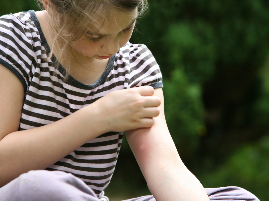 Mosquito bite